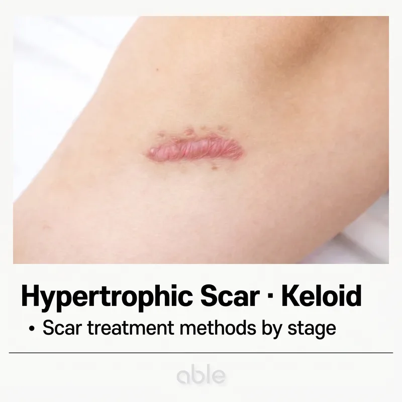 Clinical photo of a hypertrophic scar and keloid