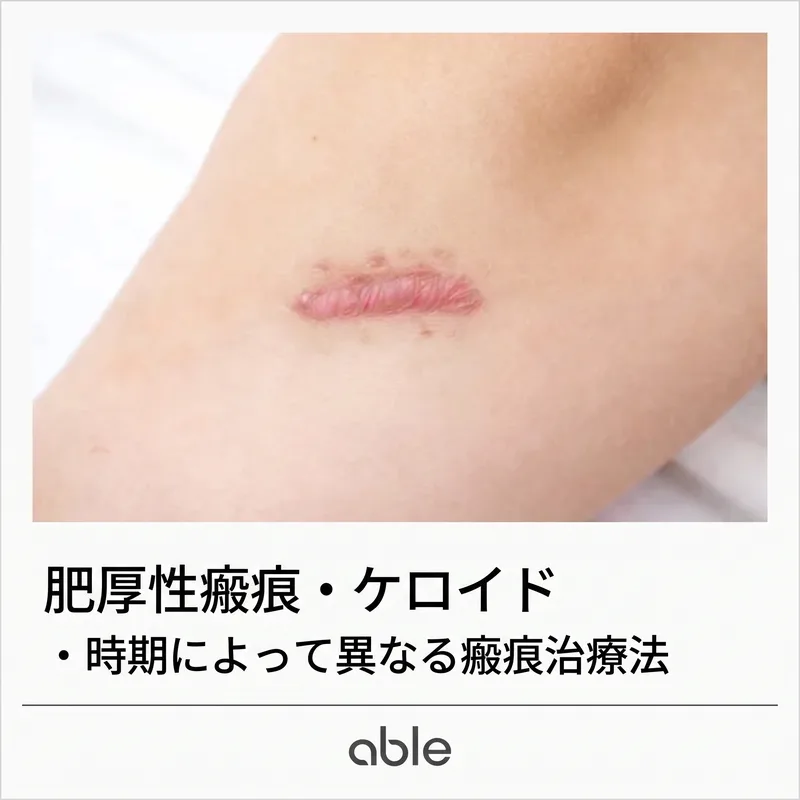 肥厚性瘢痕とケロイドの臨床写真