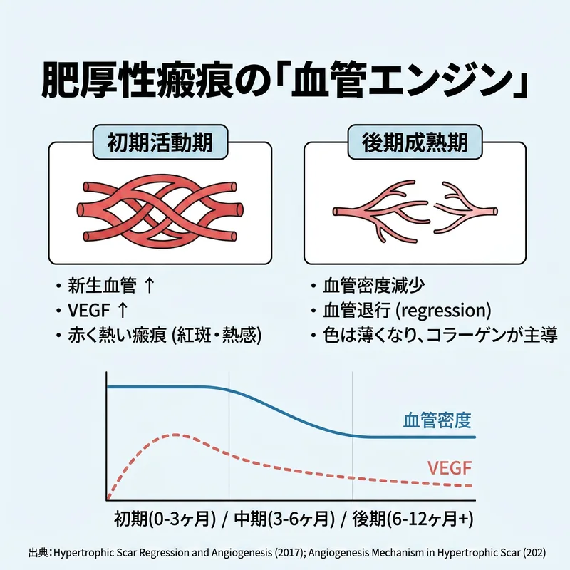 肥厚性瘢痕の血管エンジン — 初期活動期から後期成熟期への血管密度とVEGFの変化