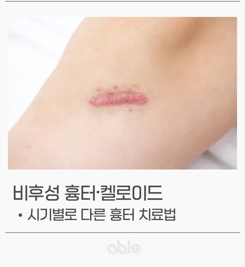 비후성 흉터와 켈로이드의 임상 사진