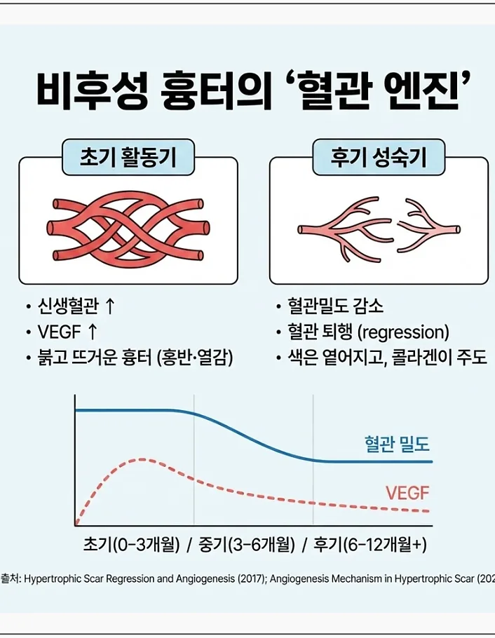 비후성 흉터의 혈관 엔진 — 초기 활동기와 후기 성숙기의 혈관 밀도 및 VEGF 변화 그래프