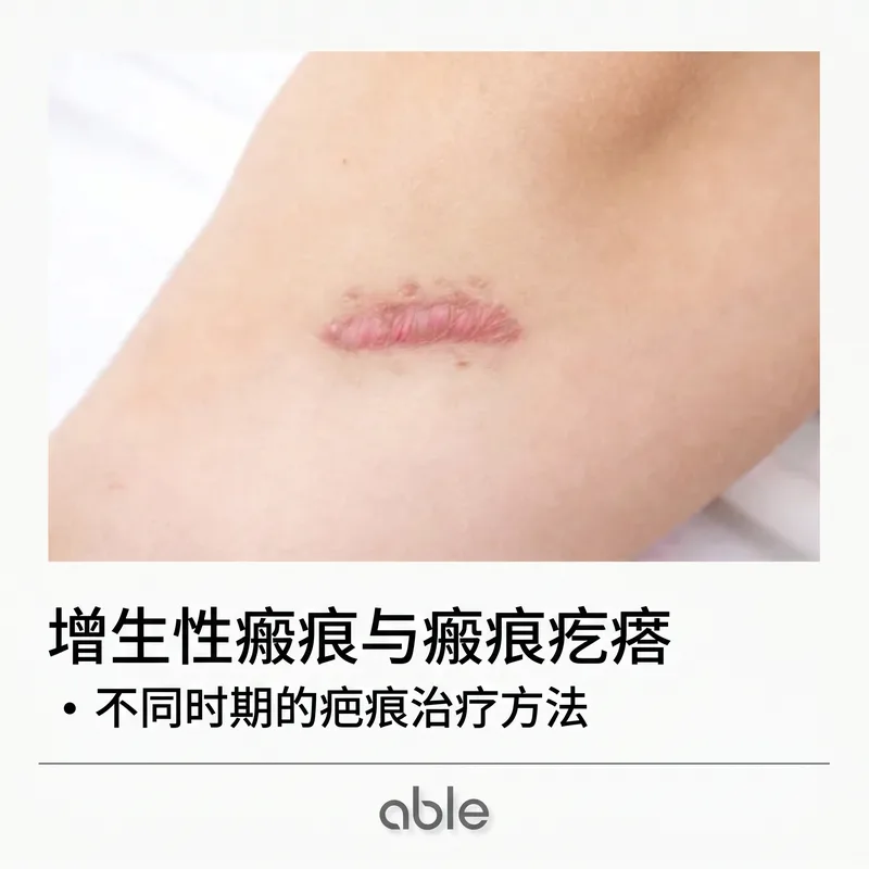 肥厚性瘢痕和瘢痕疙瘩的临床照片