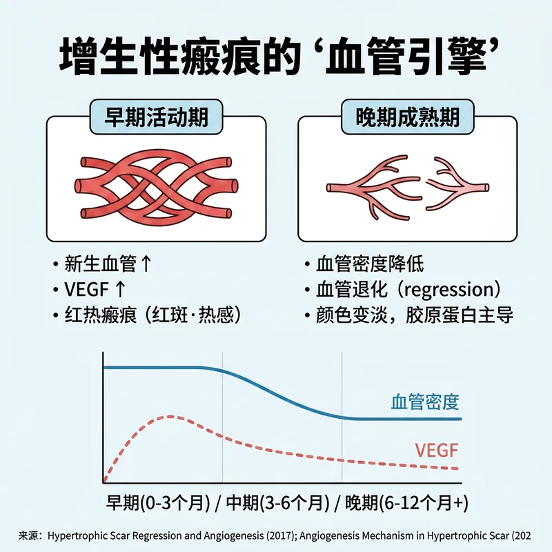 肥厚性瘢痕的血管引擎 — 早期活跃期到晚期成熟期的血管密度和VEGF变化