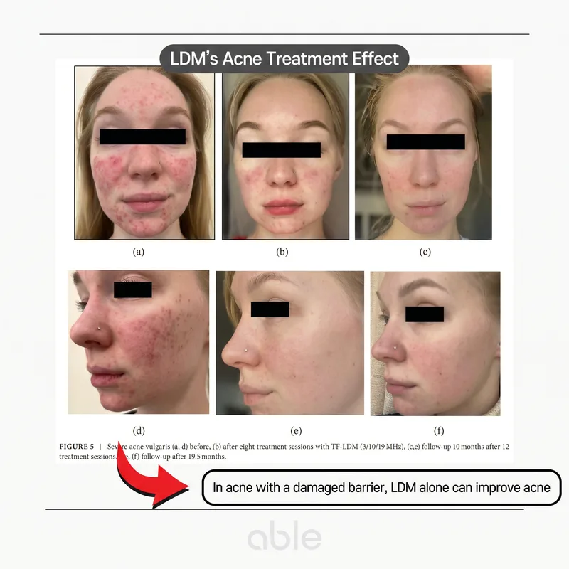 LDM acne treatment clinical photos showing improvement in barrier-damaged acne cases