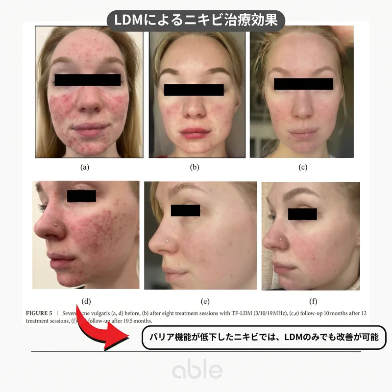 LDMニキビ治療の臨床写真 — バリア損傷ニキビでLDMのみで改善した症例