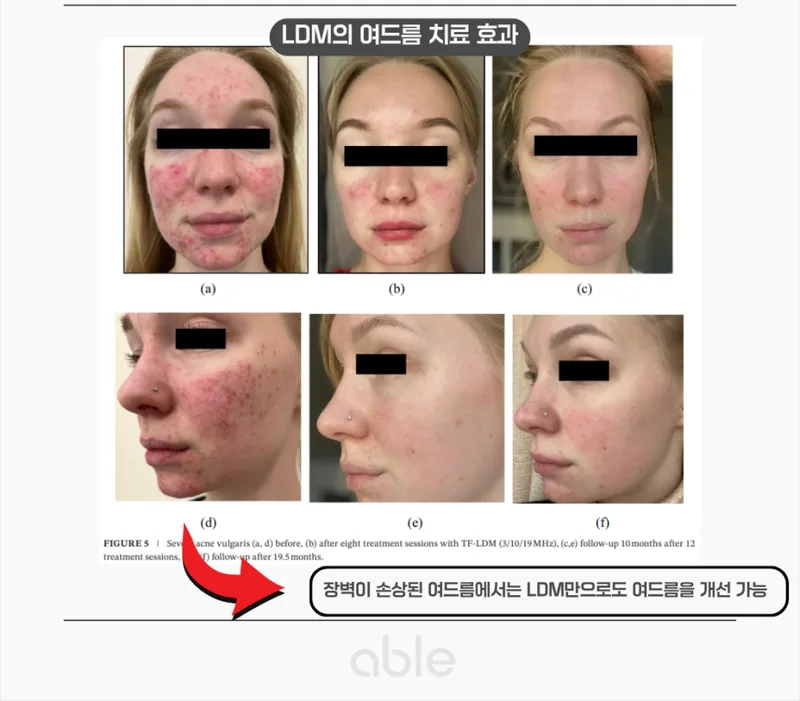 LDM 여드름 치료 효과 임상 사진 — 피부장벽이 손상된 여드름에서 LDM만으로 개선된 사례