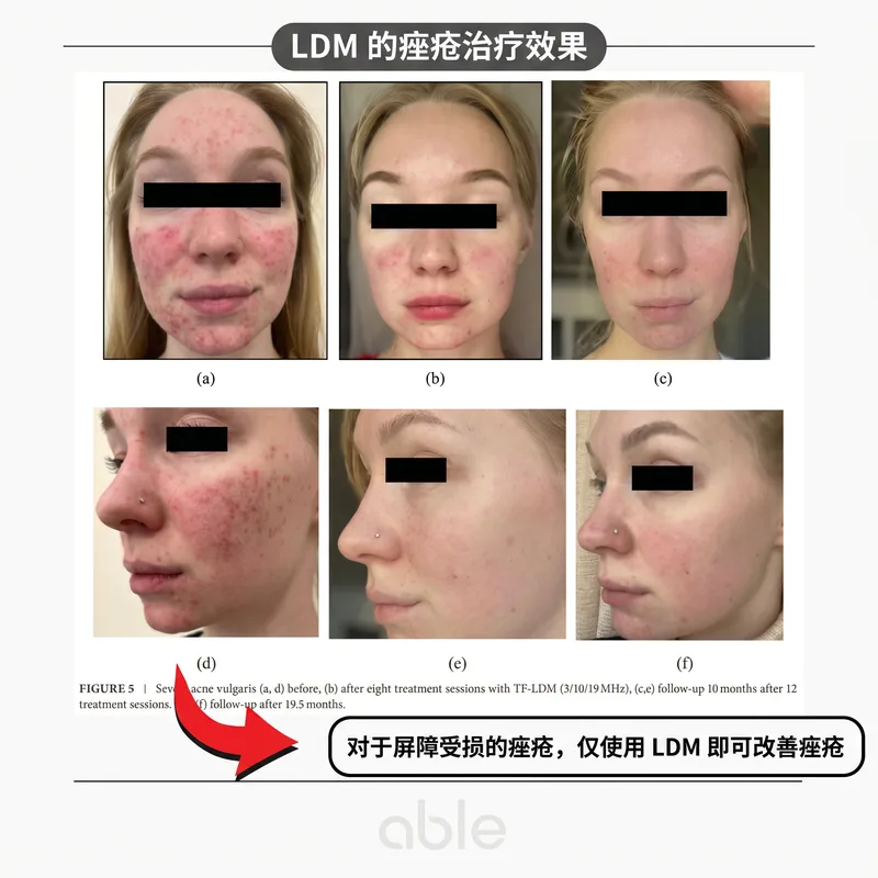 LDM痤疮治疗临床照片 — 屏障受损的痤疮仅用LDM即可改善