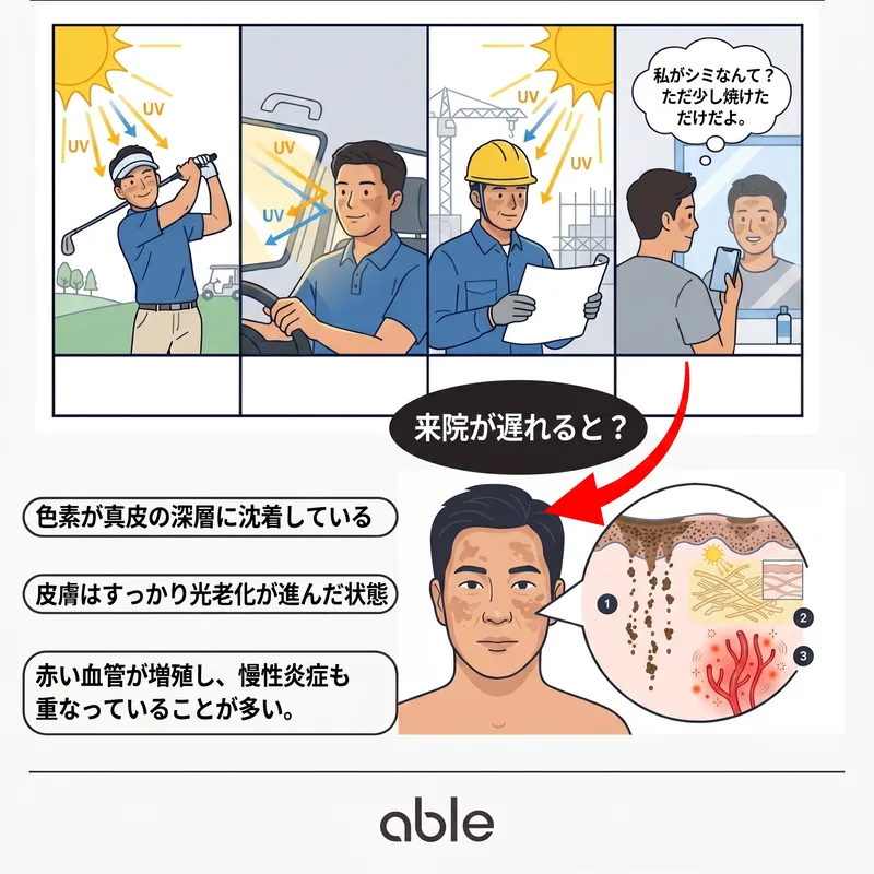 紫外線曝露シーンと遅い受診による真皮色素沈着の断面図
