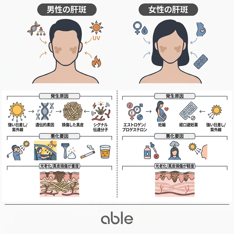 男性肝斑と女性肝斑の発生原因・悪化要因・真皮損傷を比較したインフォグラフィック