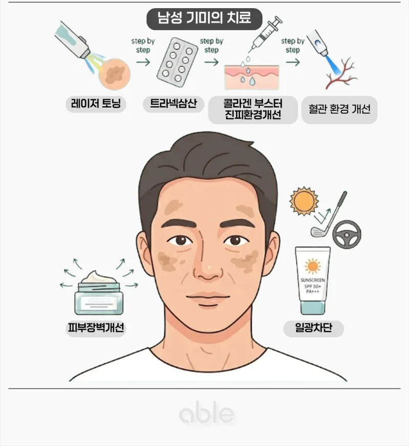 남성 기미 치료 단계별 방법 — 레이저 토닝, 트라넥삼산, 콜라겐 부스터, 혈관 치료, 자외선 차단