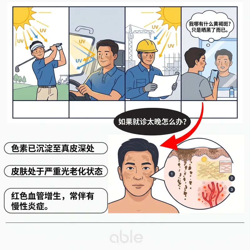 紫外线暴露场景和延迟就诊导致的真皮色素沉着截面图