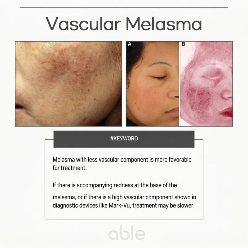 Vascular melasma clinical photo — redness-associated melasma where blood vessels feed melanocyte growth