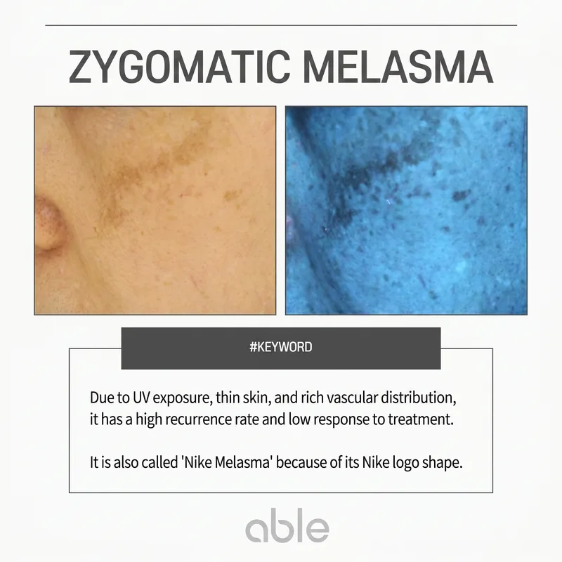Malar melasma clinical photo and Wood lamp findings — UV-exposed cheekbone area melasma