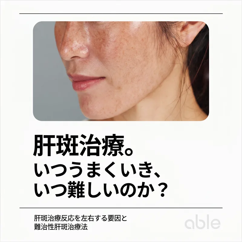 肝斑治療予後要因インフォグラフィック — 治りやすい肝斑と難しい肝斑を区別する要因