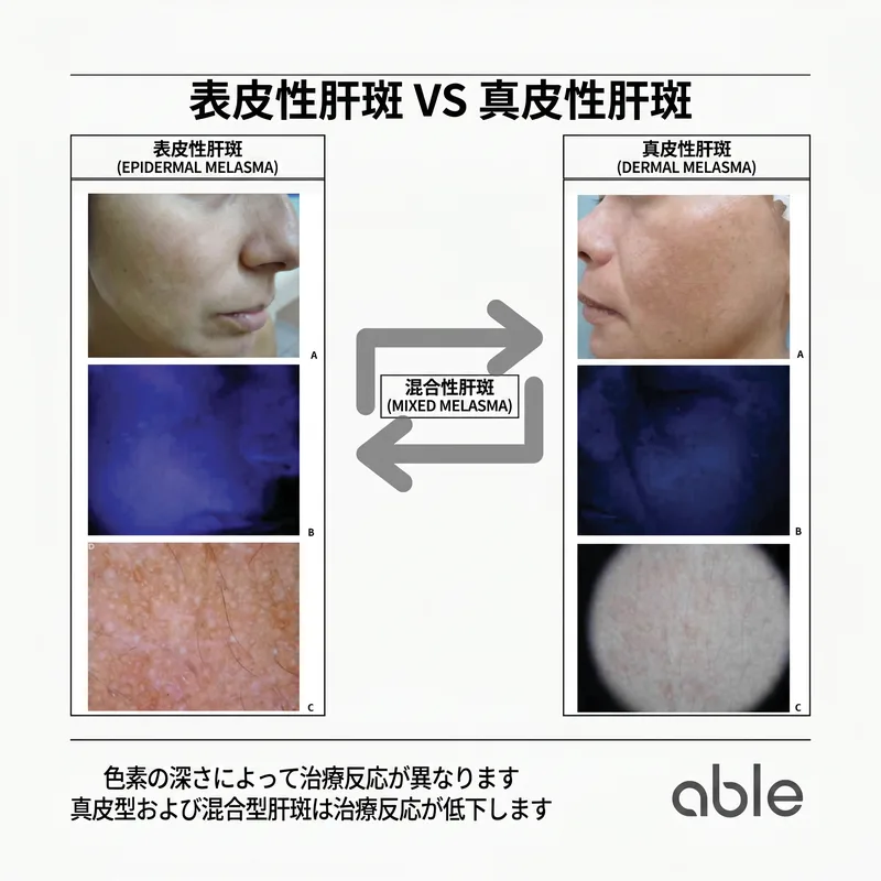 表皮性肝斑 vs 真皮性肝斑のウッドランプ比較 — 色素の深さによる治療難度の違い