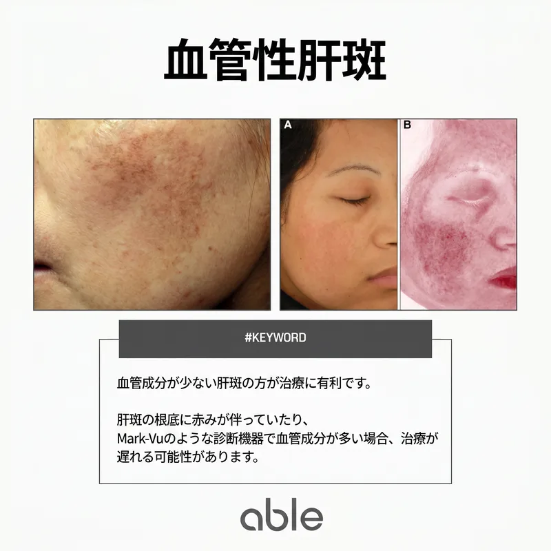 血管性肝斑の臨床写真 — 血管がメラニン細胞に成長因子を供給し再発を促進