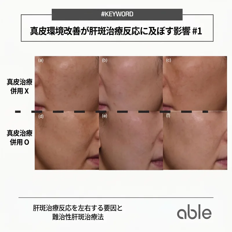 真皮環境改善の有無による治療反応の違い — 難治性肝斑での真皮治療の重要性