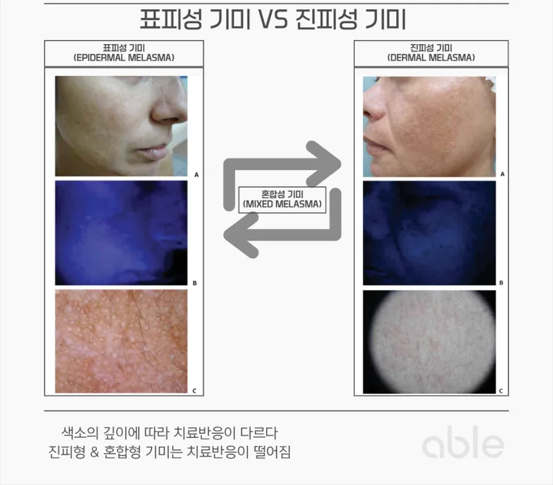 표피성 기미 vs 진피성 기미 우드등 비교 — 색소 깊이에 따른 치료 반응 차이