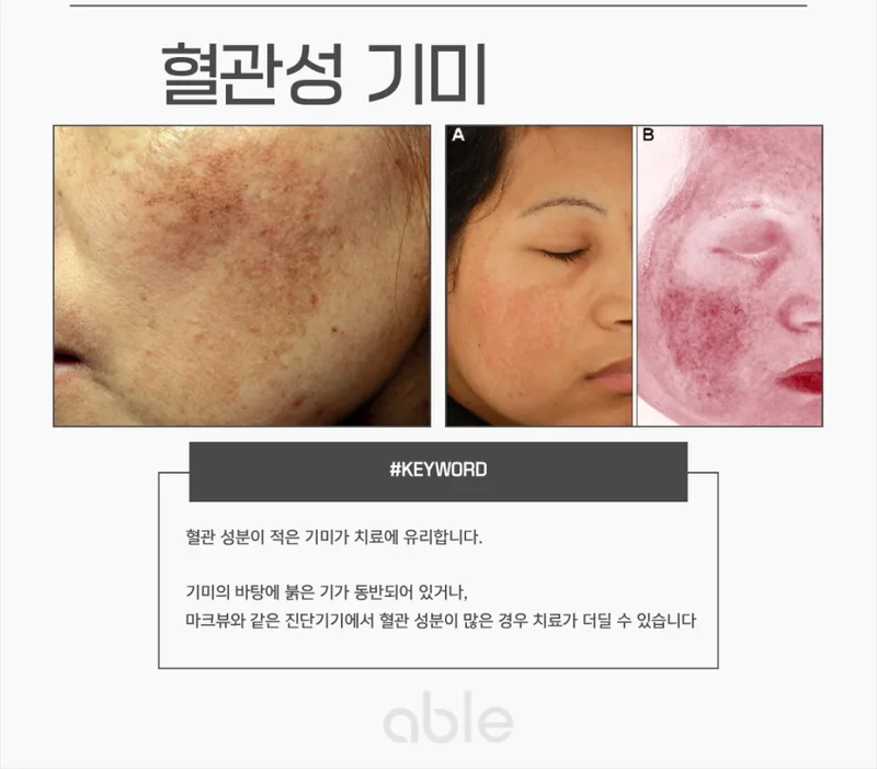 혈관성 기미 임상 사진 — 홍조를 동반한 기미에서 혈관 확장이 멜라닌 재생을 유발하는 과정