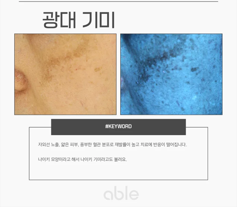 광대 기미(나이키 기미) 임상 사진과 우드등 소견 — 자외선 노출이 많은 광대뼈 부위 기미