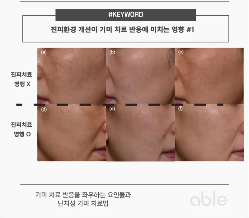 진피 환경 개선 전후 비교 — 난치성 기미에서 진피 치료 유무에 따른 치료 반응 차이