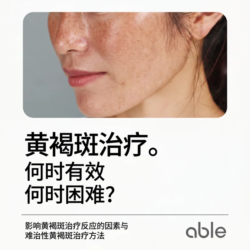 黄褐斑治疗预后因素信息图 — 区分好治与难治黄褐斑的因素