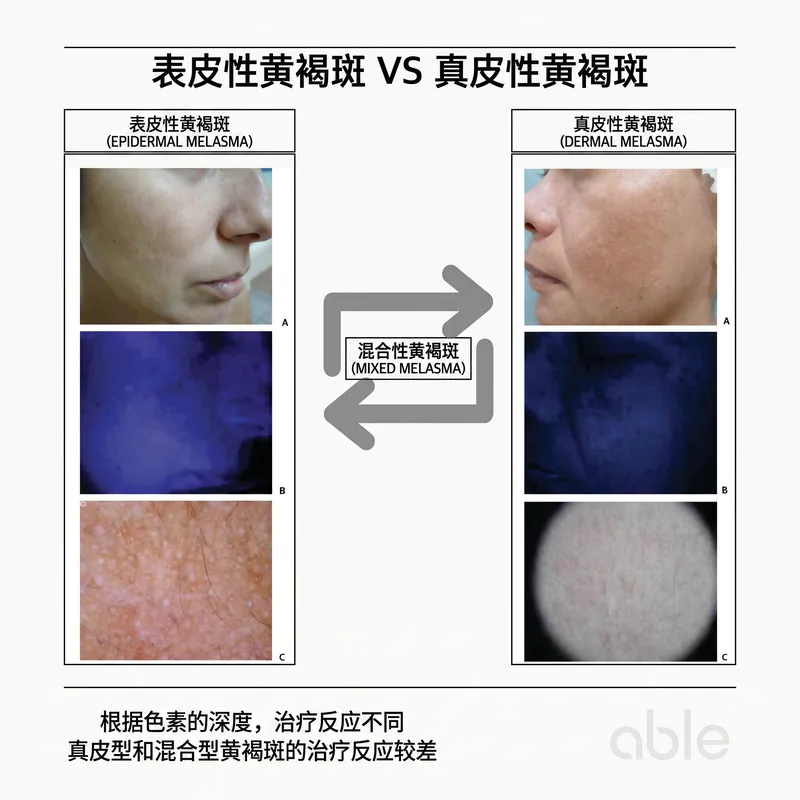 表皮型 vs 真皮型黄褐斑Wood灯对比 — 色素深度决定治疗难度