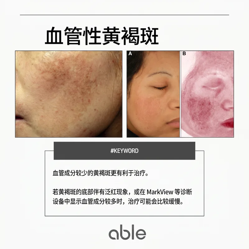 血管性黄褐斑临床照片 — 血管向黑色素细胞提供生长因子导致复发