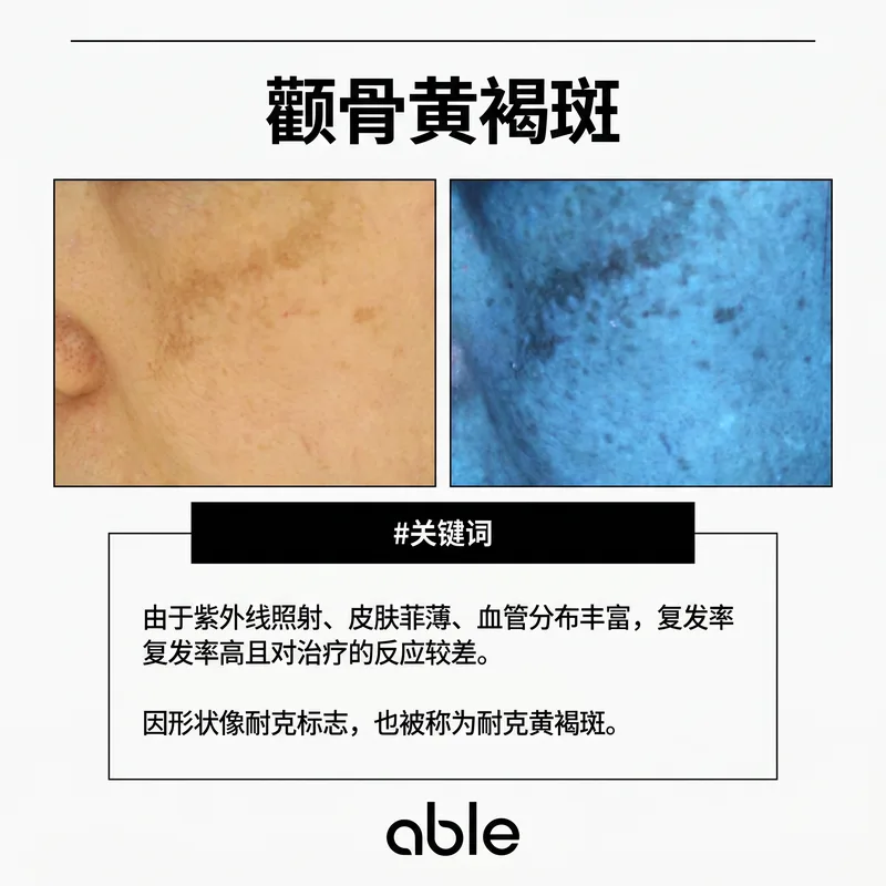 颧骨部位黄褐斑临床照片及Wood灯表现 — 紫外线暴露多的颧骨区域黄褐斑