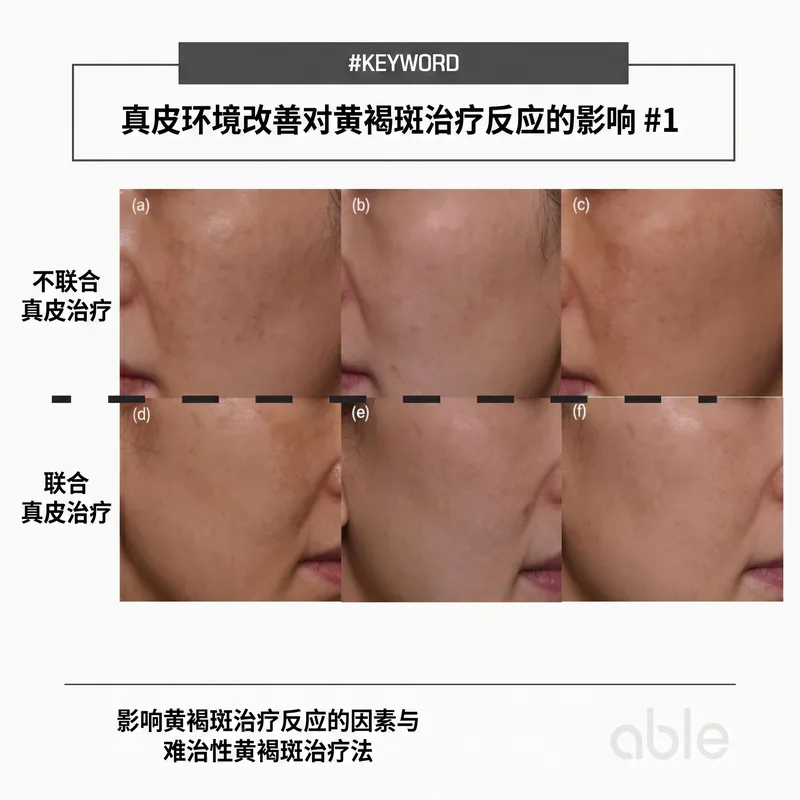 真皮环境改善前后对比 — 难治性黄褐斑中真皮治疗与否的治疗反应差异