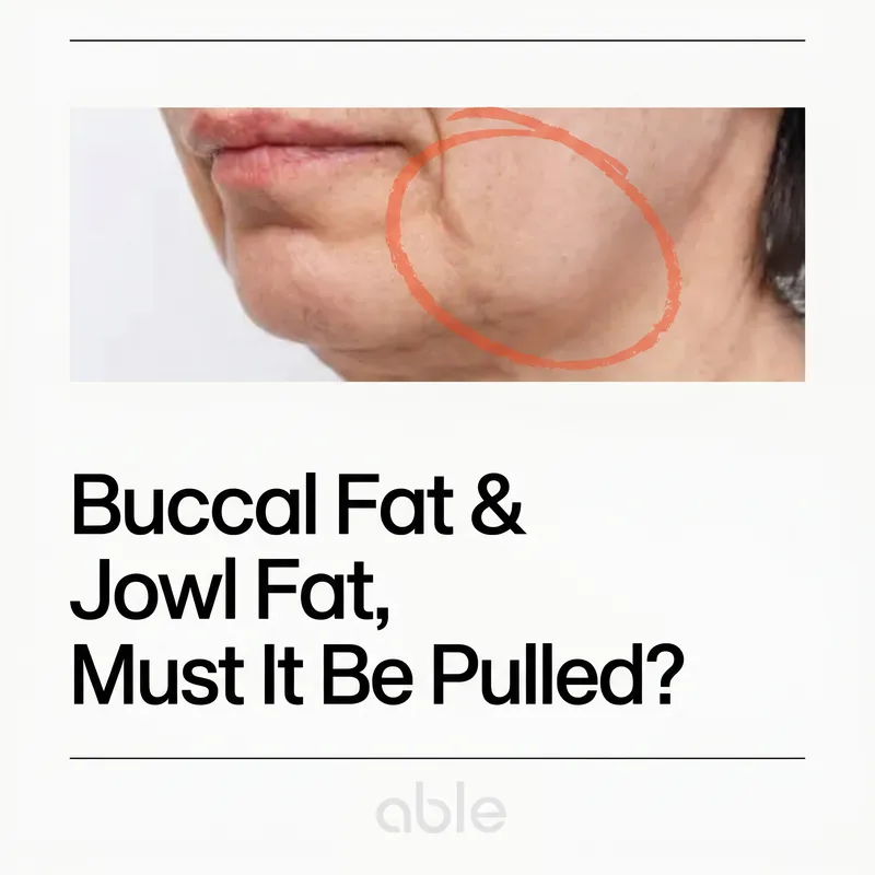 Side view of deep-cheek sagging and jowls — structural cause that responds to filling, not pulling