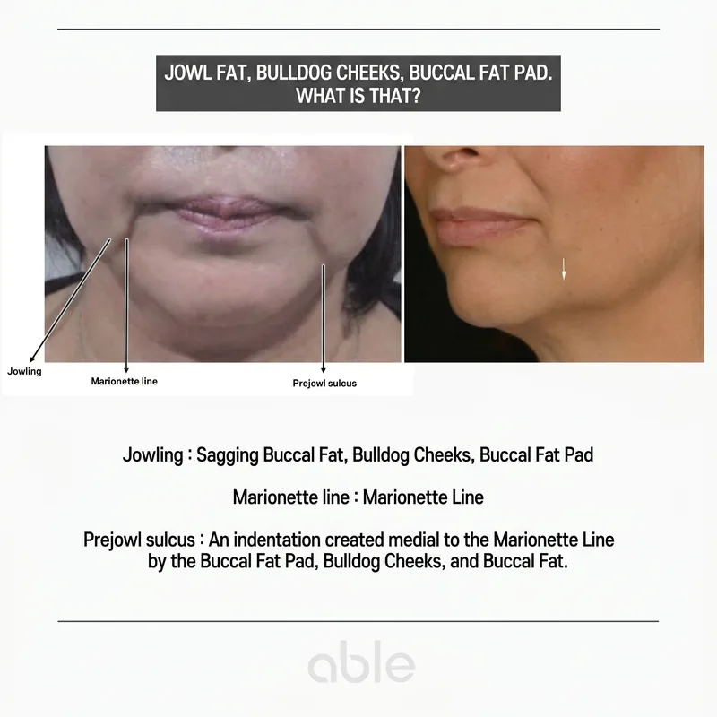 Anatomical comparison of jowling, marionette line, and prejowl sulcus