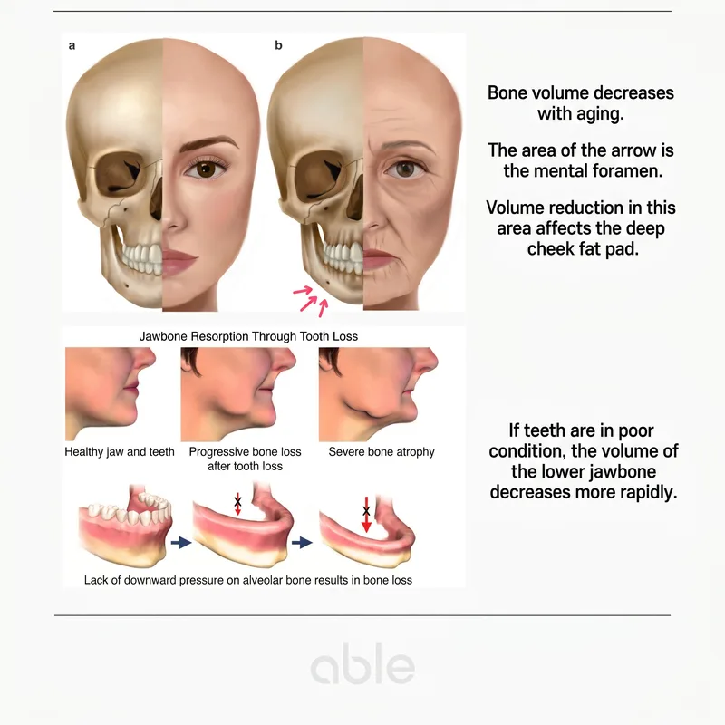 Age-related facial skeletal changes — bone resorption around mental foramen and mandibular volume loss