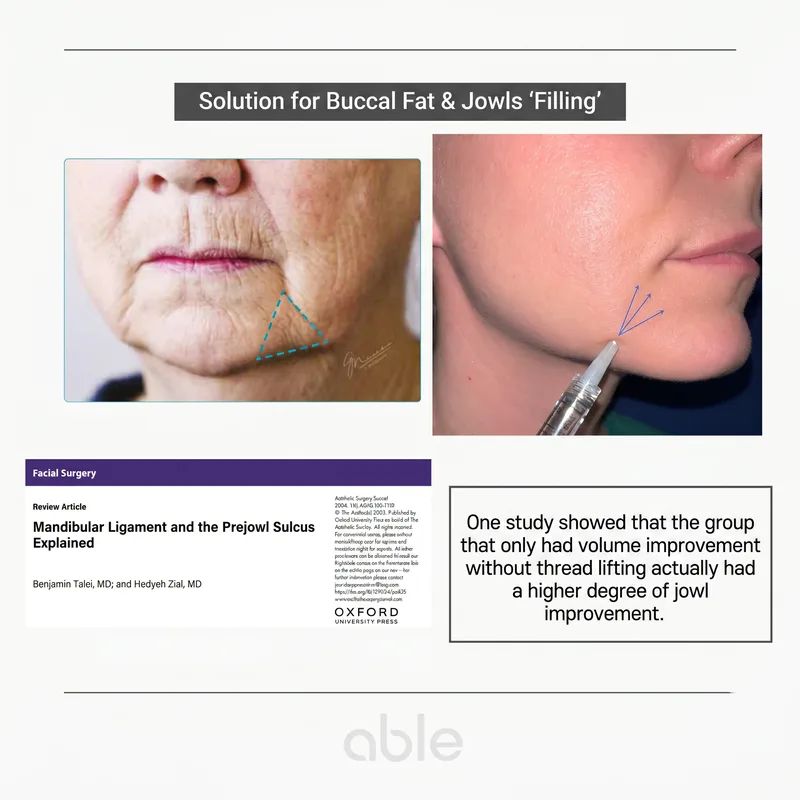 Injection sites for marionette filler — mandibular ligament and prejowl sulcus with academic references