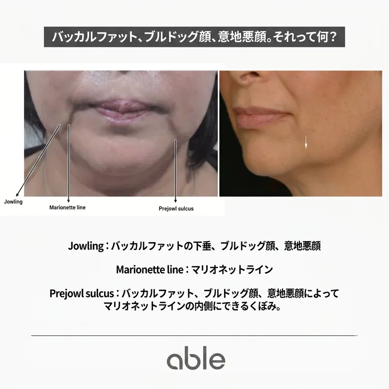 Jowling、マリオネットライン、Prejowl sulcusの解剖学的比較