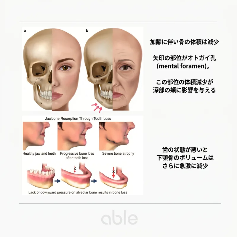 加齢に伴う顔面骨格の変化 — mental foramen周囲の骨吸収と下顎骨容積減少