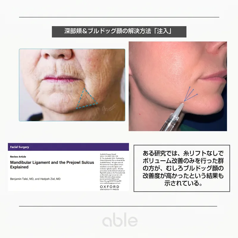 マリオネットフィラーの注入位置 — Mandibular ligament・prejowl sulcusと学術論文