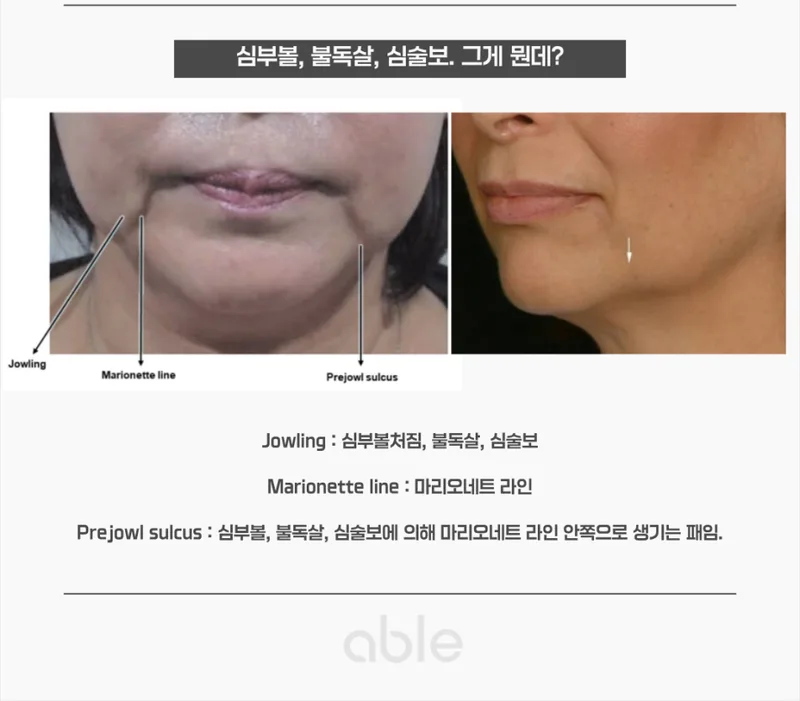Jowling, 마리오넷 라인, Prejowl sulcus의 해부학적 비교