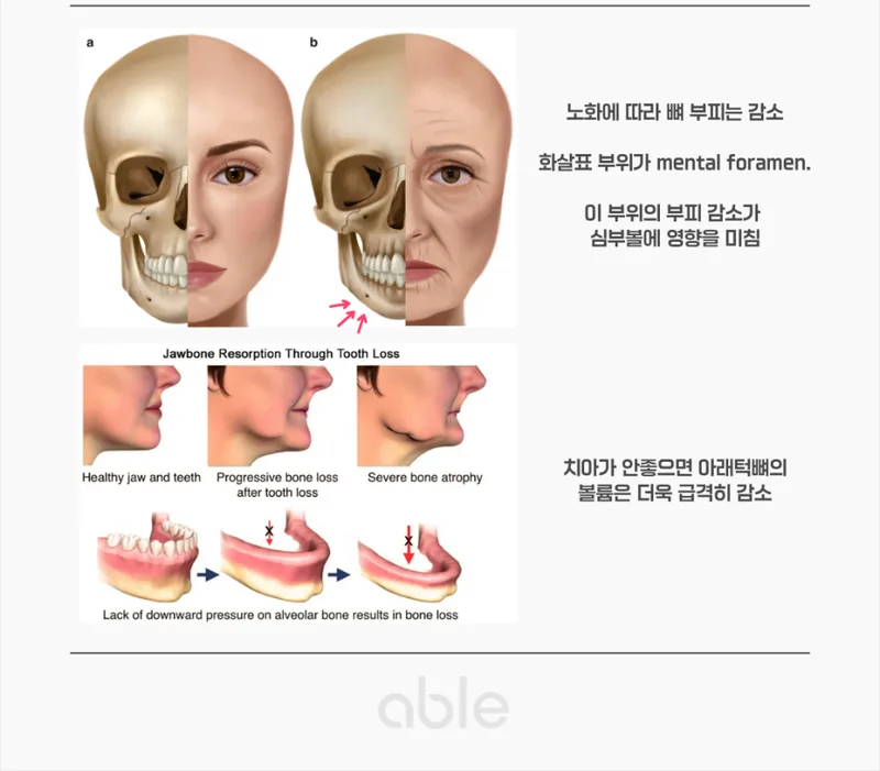 노화에 따른 안면 골격 변화·턱뼈 흡수 — mental foramen 주변 골흡수가 심부볼에 미치는 영향