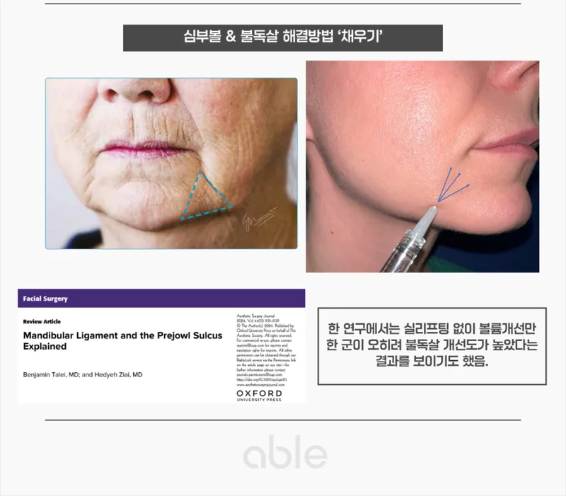 심부볼·불독살 해결을 위한 필러 주입 위치 및 학술 논문 레퍼런스