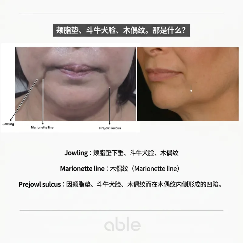 Jowling、木偶纹、Prejowl sulcus的解剖学比较