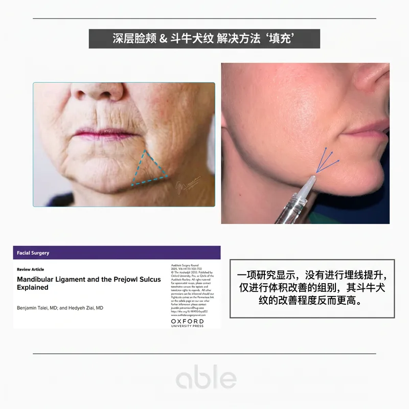 木偶纹填充注射位置 — 下颌韧带·prejowl sulcus及学术论文
