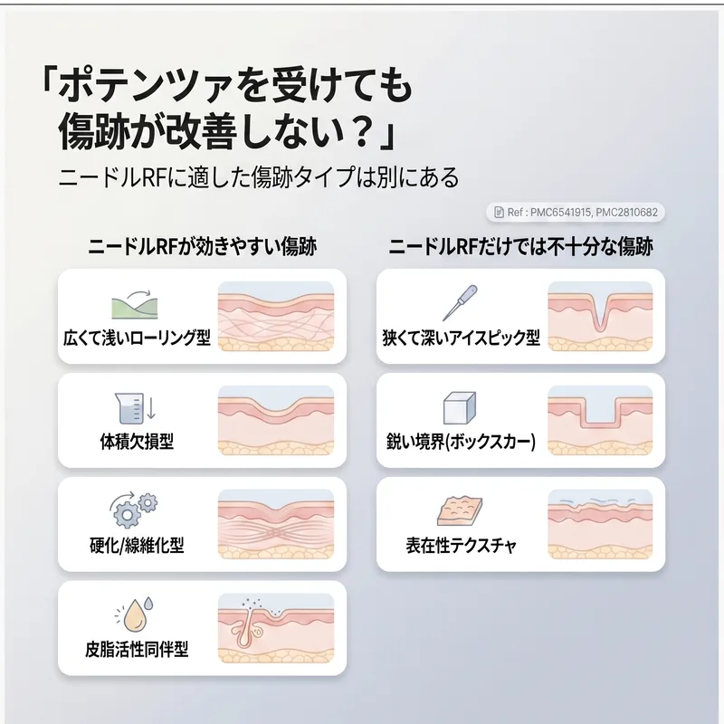 ニードルRFに反応する瘢痕タイプと限界のある瘢痕タイプの比較