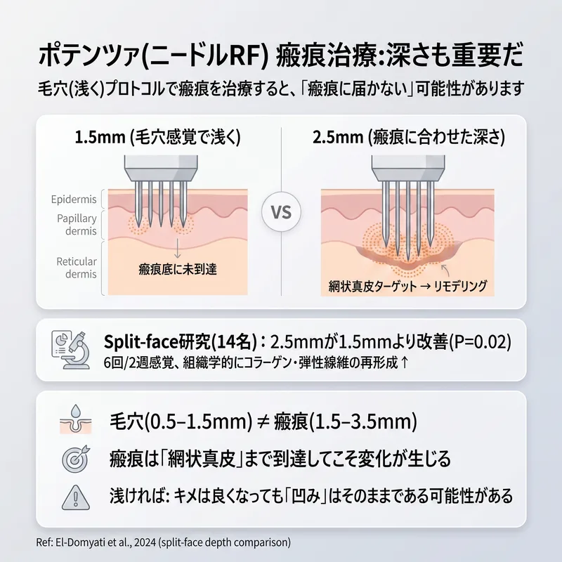 ポテンツァ針深度比較 — 毛穴用1.5mm vs 瘢痕用2.5mmの治療深度の違い