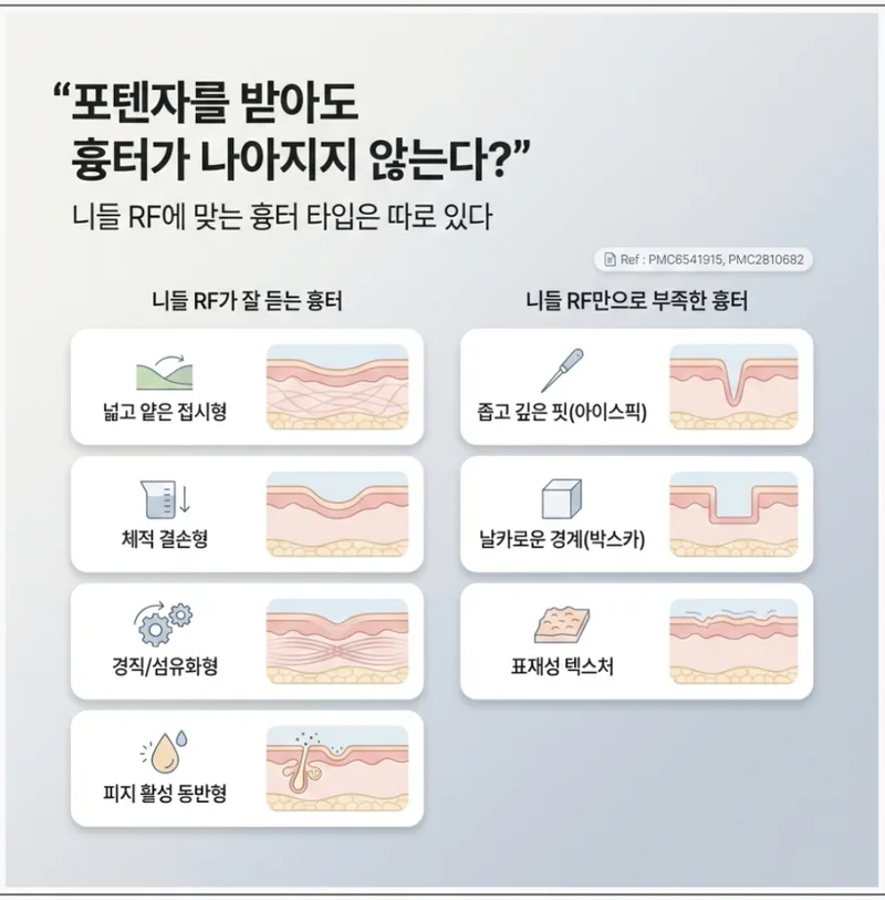 니들RF에 잘 듣는 흉터 유형과 부족한 흉터 유형 비교 인포그래픽