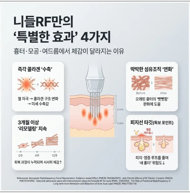니들RF의 4가지 특별한 효과 인포그래픽 — 콜라겐 수축, 섬유조직 연화, 리모델링, 피지선 타깃