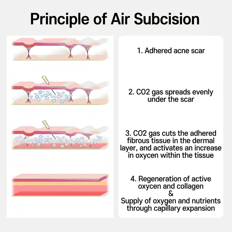 Air subcision mechanism: 4-step cross-section showing CO2 gas injection releasing adhesions and inducing collagen regeneration