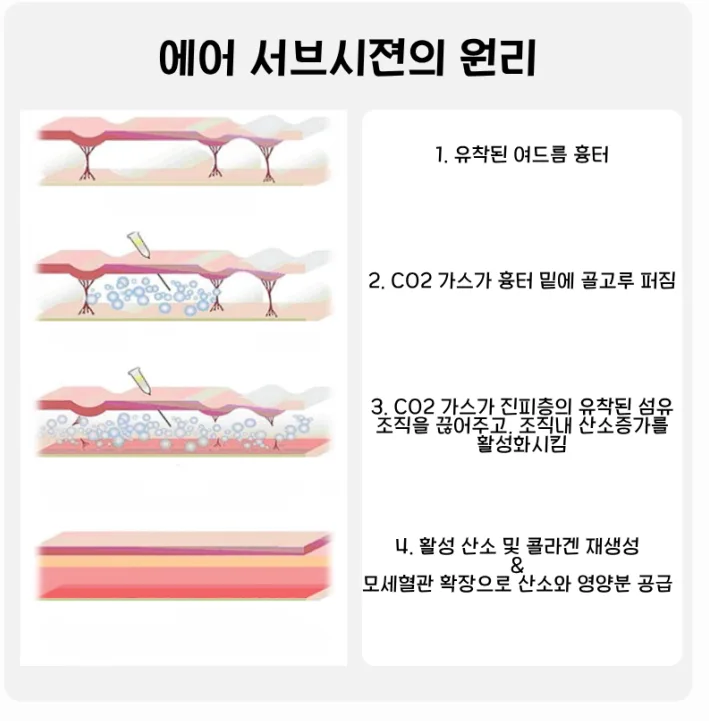 에어서브시전의 원리: CO2 가스 주입으로 유착 해제와 콜라겐 재생을 유도하는 4단계 과정 단면도