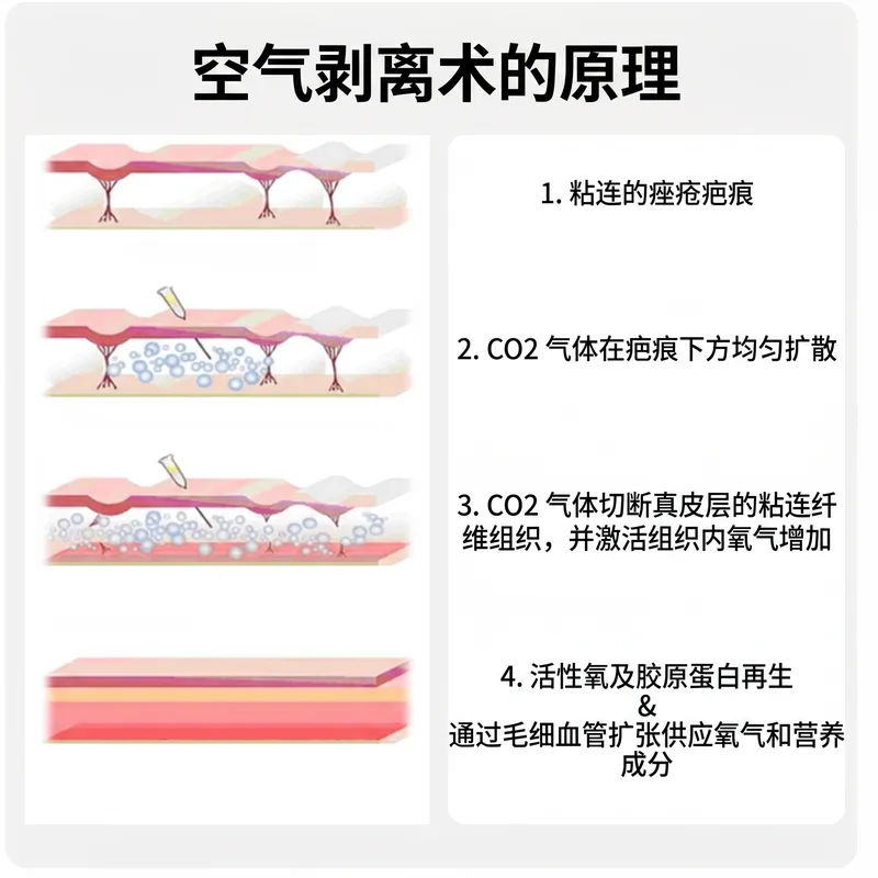气动皮下分离术原理：CO2气体注射解除粘连并诱导胶原蛋白再生的4步截面图