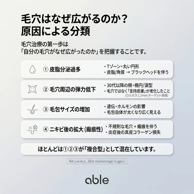 毛穴拡大の3つの原因：皮脂過多・弾力低下・傷跡タイプ別比較イラスト